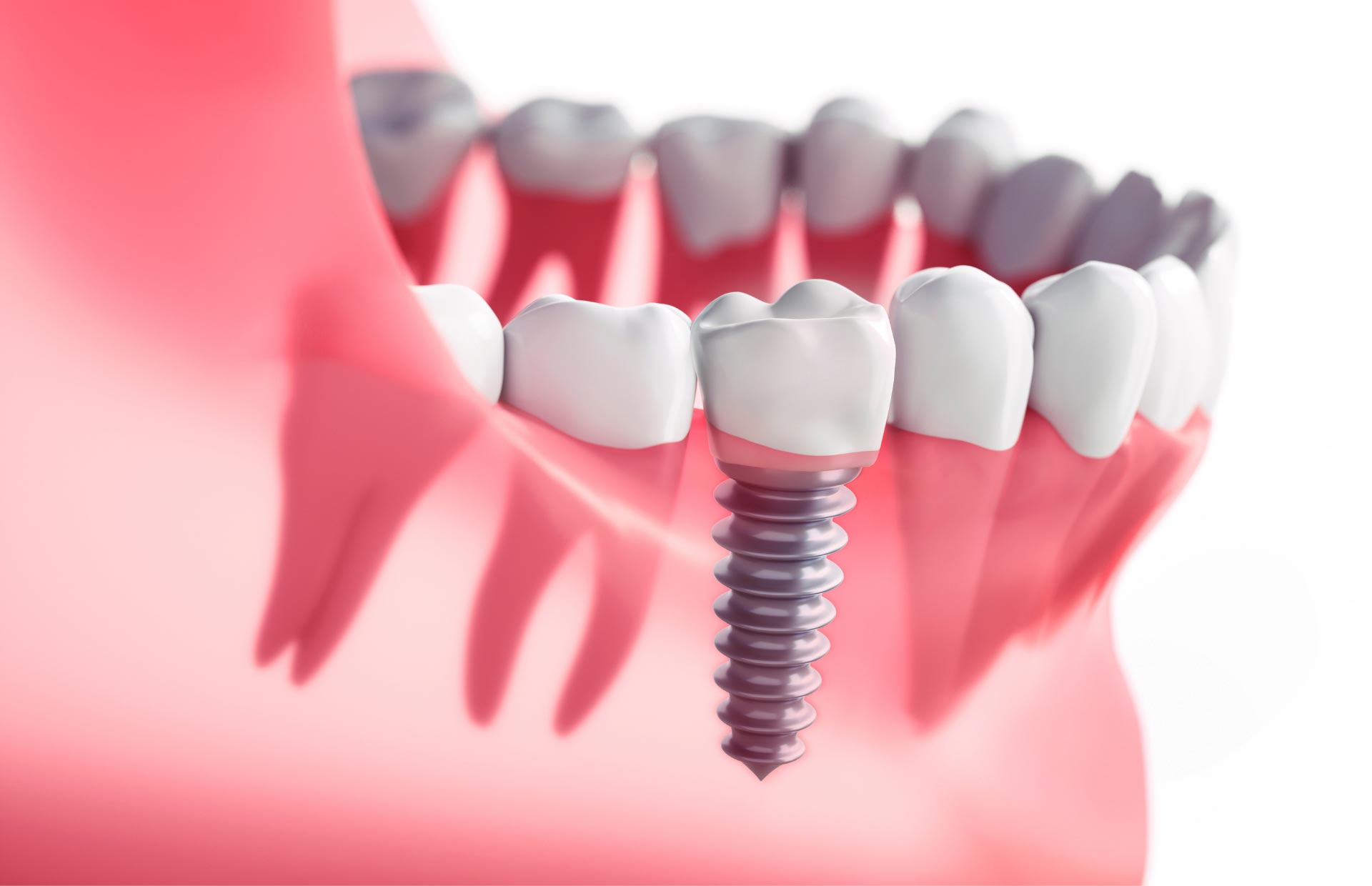 Implantologia Dentale​